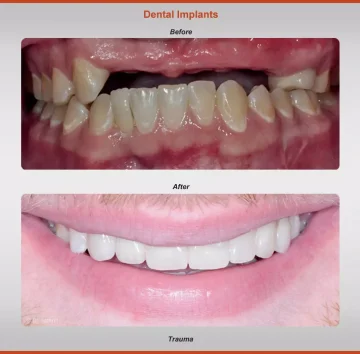 2018-implants-case-2