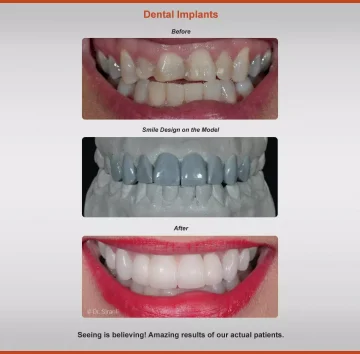 2018-implants-case-3