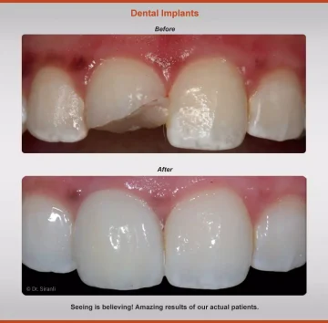 2018-implants-case-4