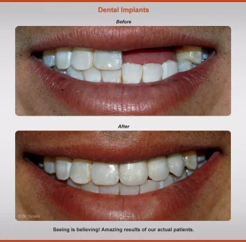 2018-implants-case-5