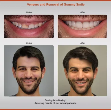 Dental Veneers