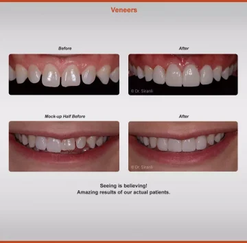 2020-veneers-1