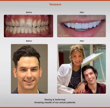 2020-veneers-3