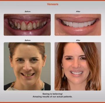 2020-veneers-4