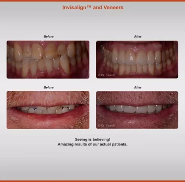 2020-veneers-invisalign