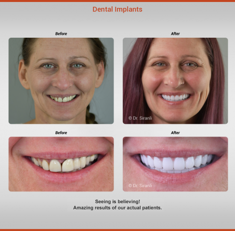 before-after-christina-gallery