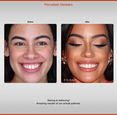 siranli-smile-gallery-1125