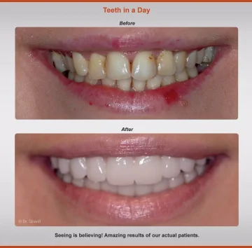 teeth-in-a-day-before-after