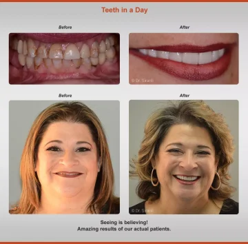 teeth-in-a-day-before-after